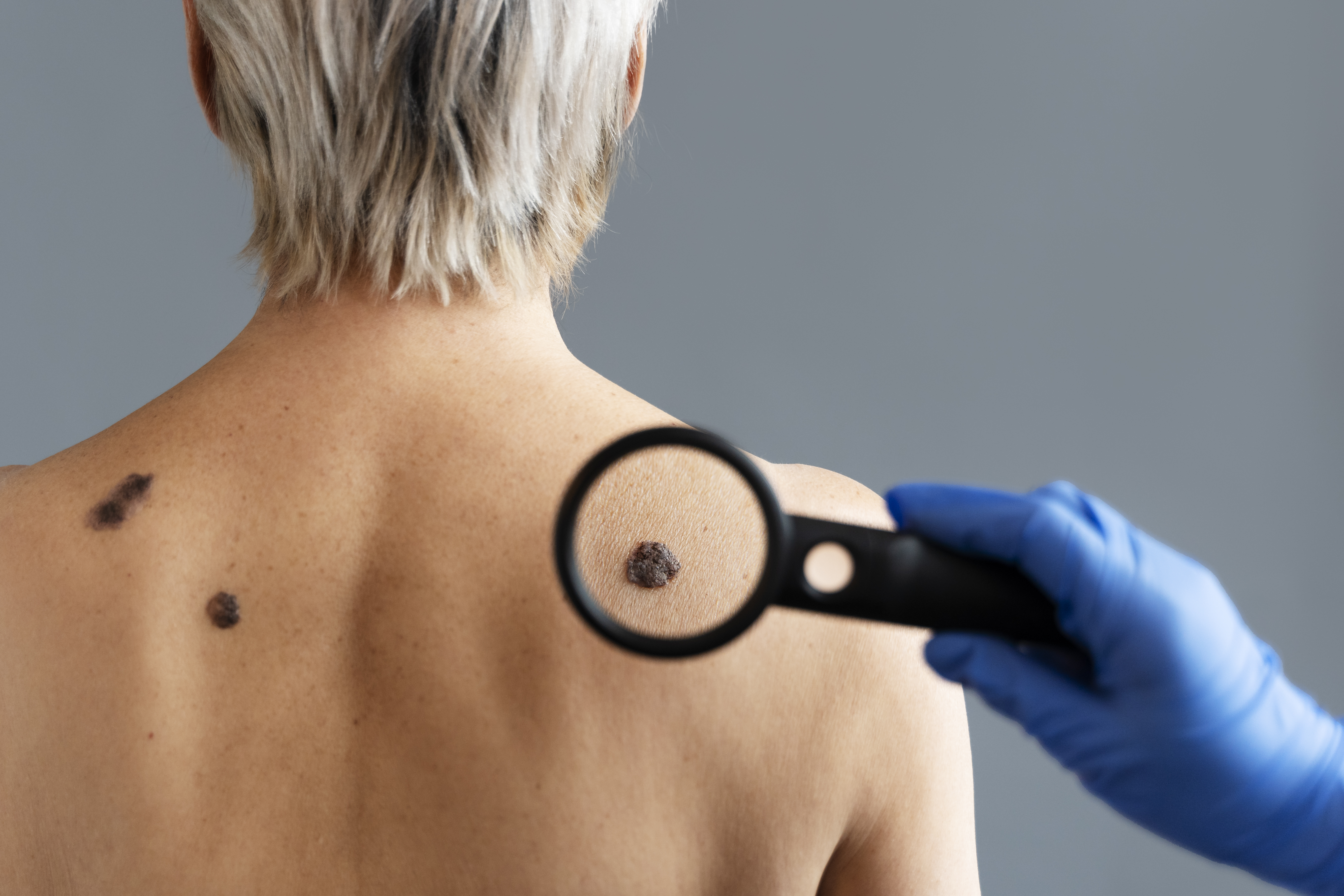 skin-cancer