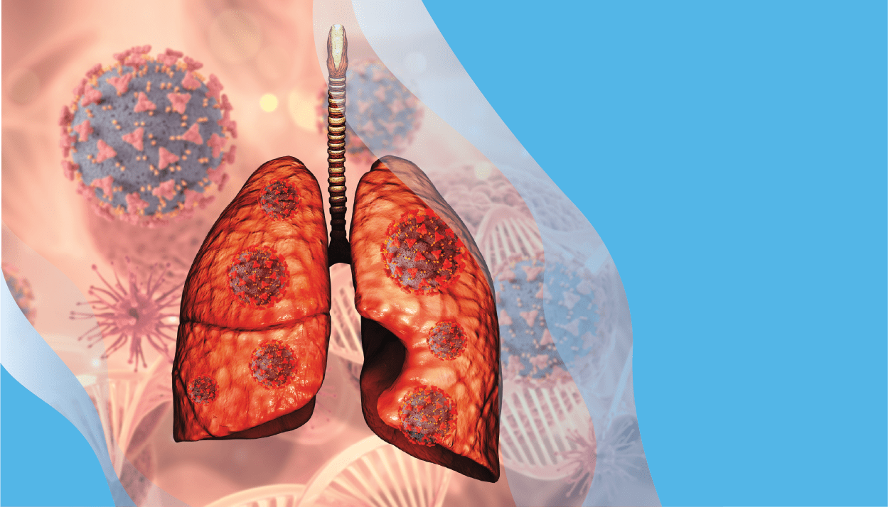 Lung-cancer