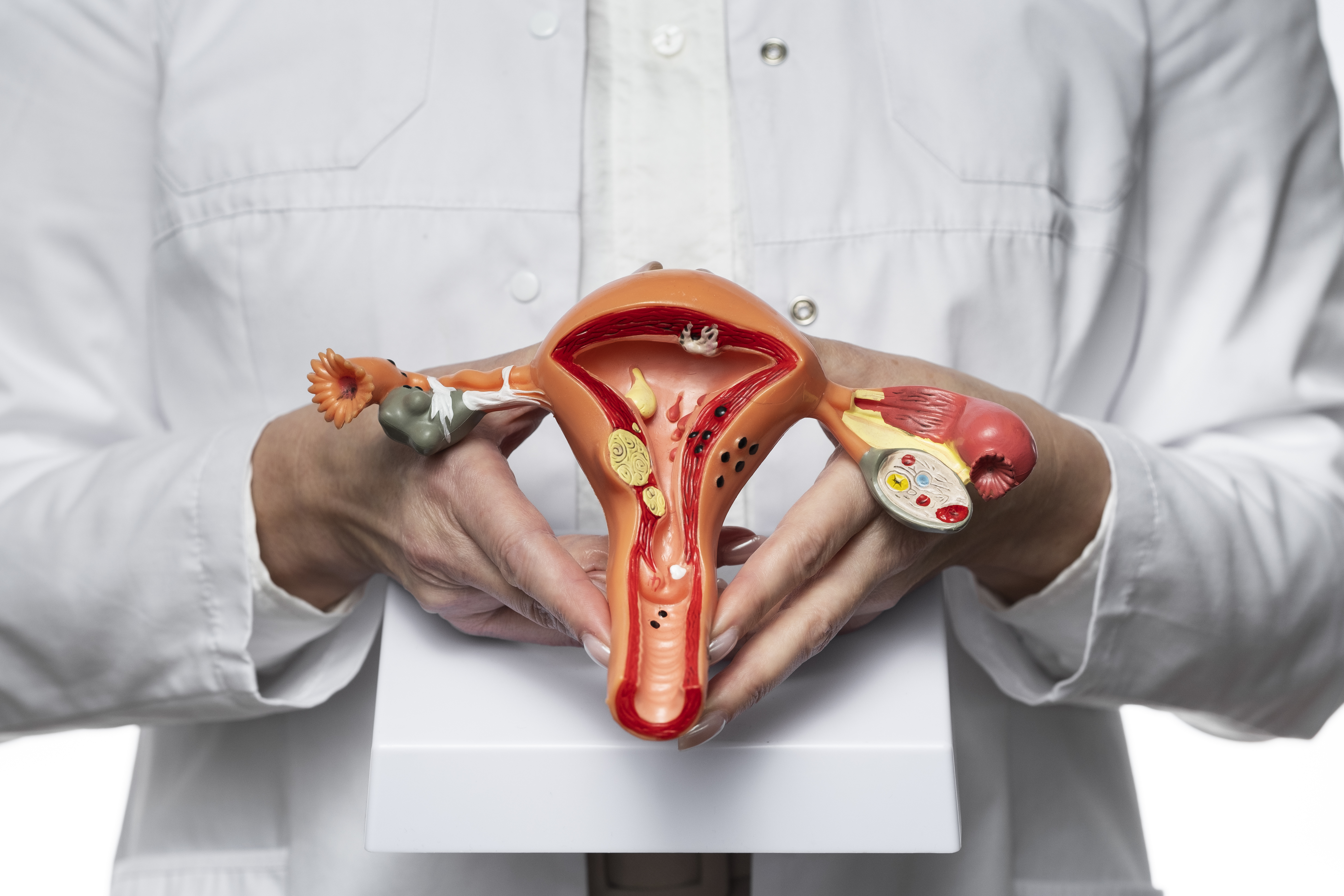 Ovarian Cancer