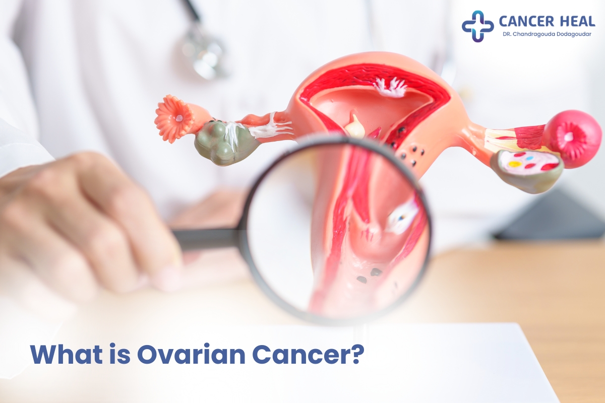 Ovarian Cancer Specialist in Delh NCR, India